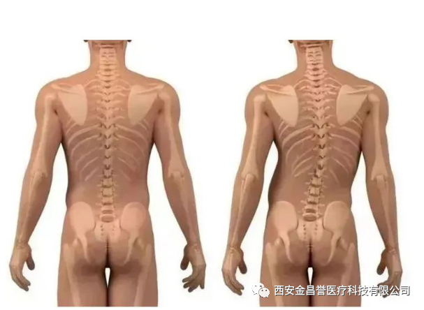 青少年脊柱側(cè)彎科普月，金昌譽(yù)與您一同守護(hù)青少年脊柱健康